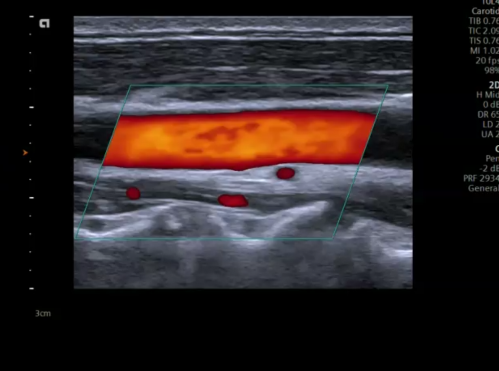 Ultrazvuk krvnih žila vrata